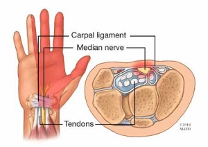 Carpal Tunnel Syndrome - My Family Physio